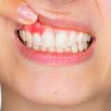¿Qué es el curetaje dental?