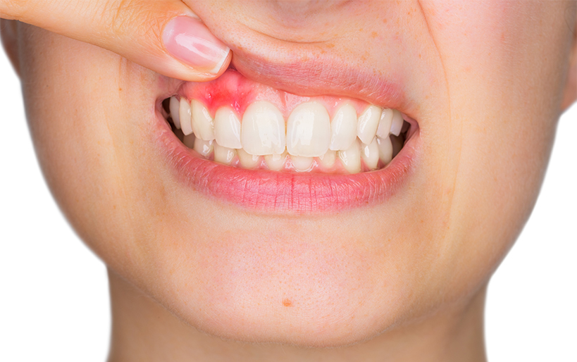 ¿Qué es el curetaje dental?