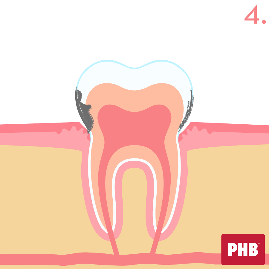 formacion caries dentales